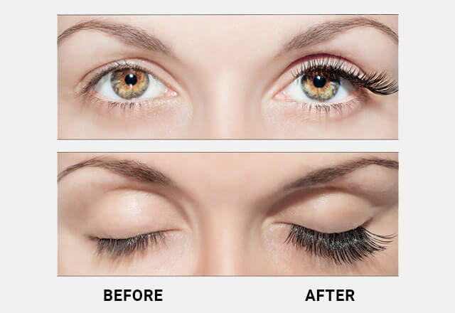 latisse eye discoloration