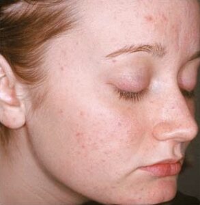 Azcone Gel Online Prescription for acne