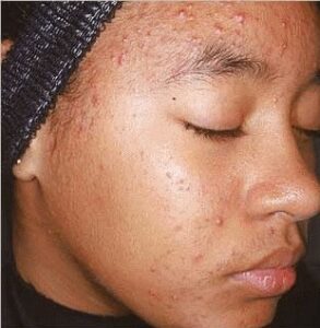 Aczone Gel acne treatment for dark skin online aczone gel prescription