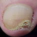 Penlac Nail Prescription for Moderate fungus nail infection