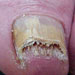 Severe Nail fungus infection not a candidate for Penlac prescription
