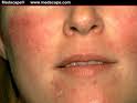 Rosacea Symptoms Facial Redness - Soolantra prescription online