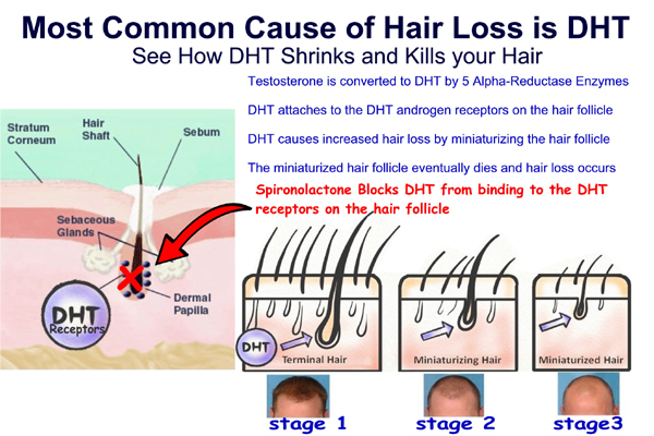 Topical Spironolactone for Male Pattern Hair loss
