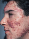 Grade IV acne