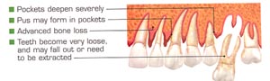 Severe Periodontitis  periostat