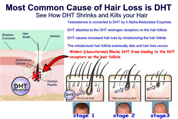 Winlevi Clascoterone blocks DHT binding to hair androgen receptor