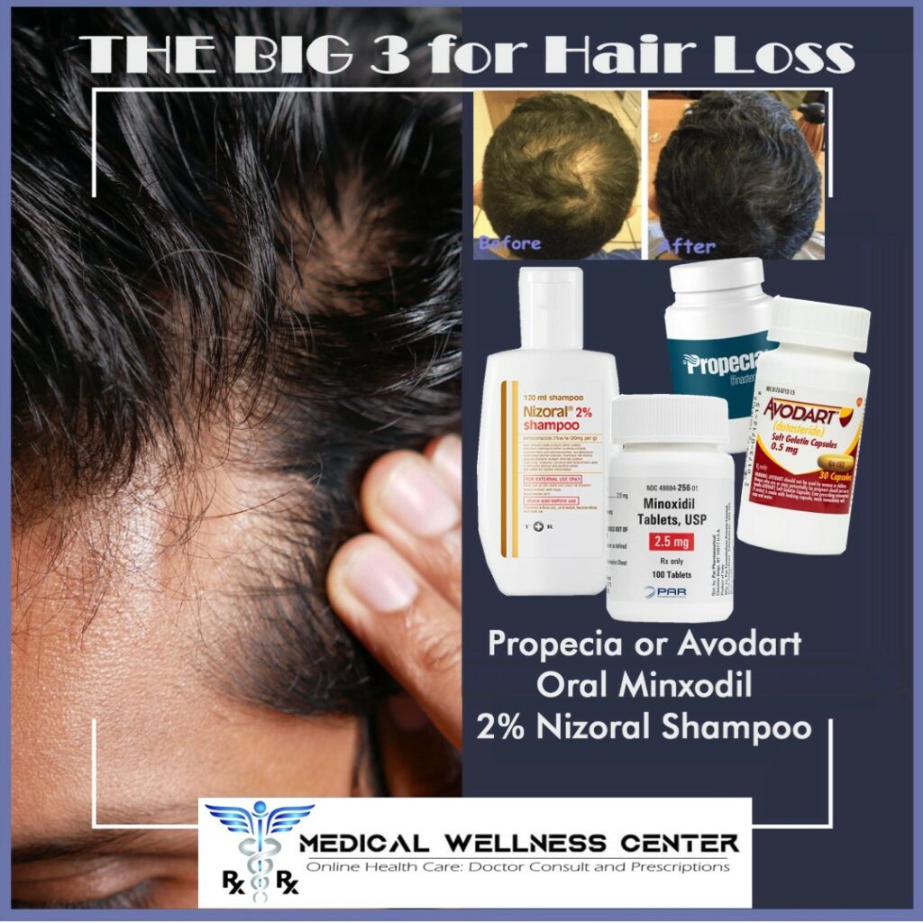The BIG 3 for hair loss - Finasteride or Dutasteride - Oral minoxidil and Nizoral (ketoconazole) shampoo Medical Wellness Center