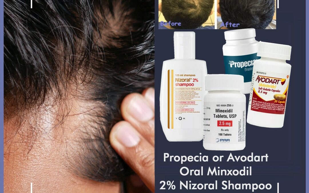 The Big Three for Hair Loss: Finasteride-Dutasteride, Oral Minoxidil & Nizoral Shampoo