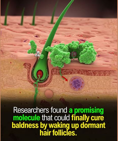 Exciting Medical Breakthrough: PP405 – New Drug May Provide Cure for Male Pattern Hairloss